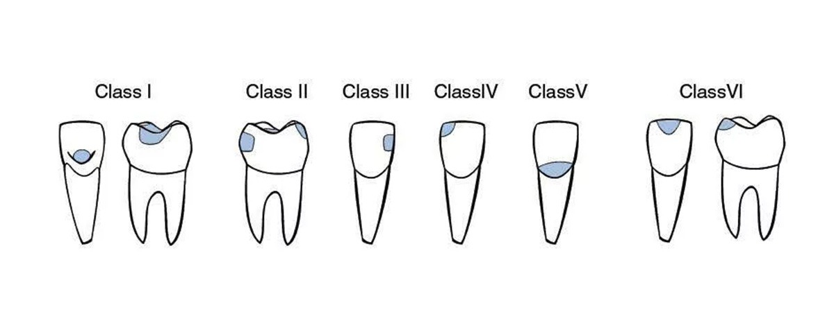 Classifications of dental caries